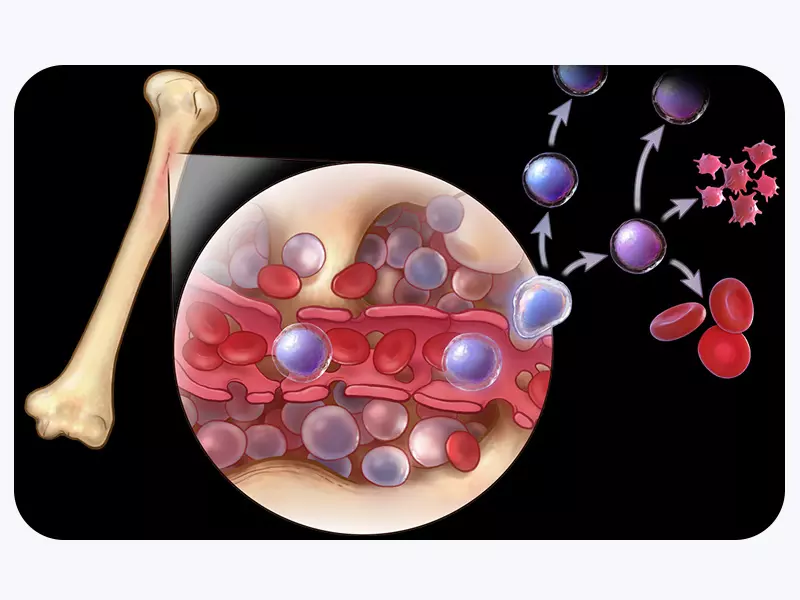 در پیوند مغز استخوان چه اتفاقی می افتد؟