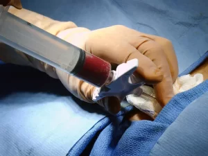 آنچه باید در مورد پیوند مغز استخوان بدانید