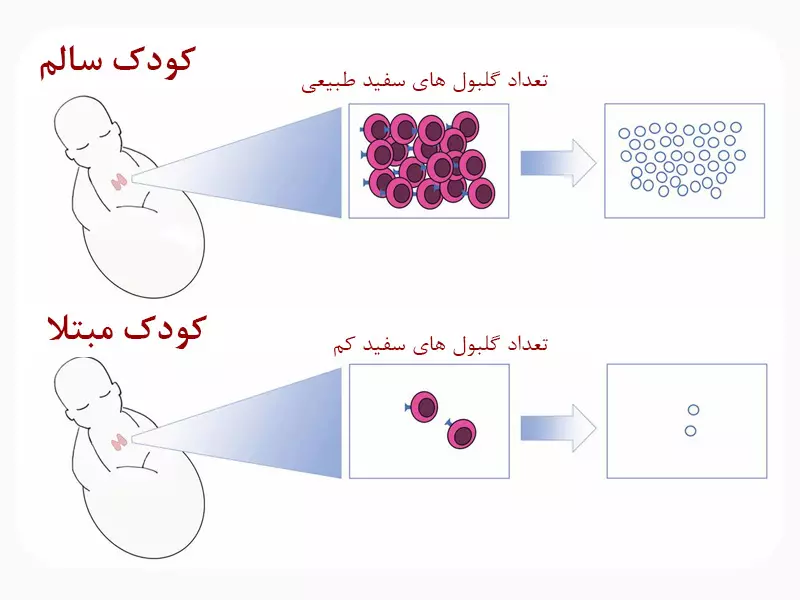 تعداد گلبول ها در بیماری نقص ایمنی مرکب شدید