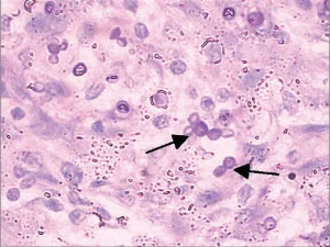 بیماری گرانولوماتوز مزمن