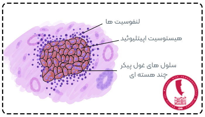 بیماری گرانولوماتوز مزمن چیست