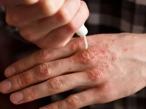 بیماری نقص ایمنی و پوست