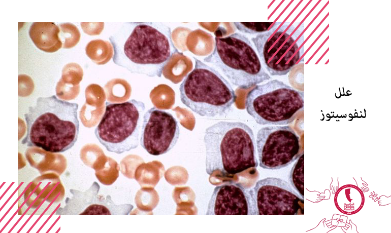 علل لنفوسیتوز