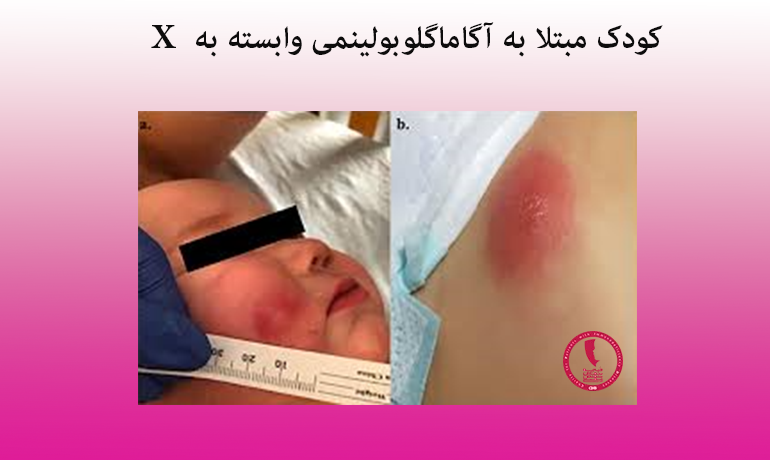 کودک مبتلا به آگاماگلوبولینمی وابسته به X
