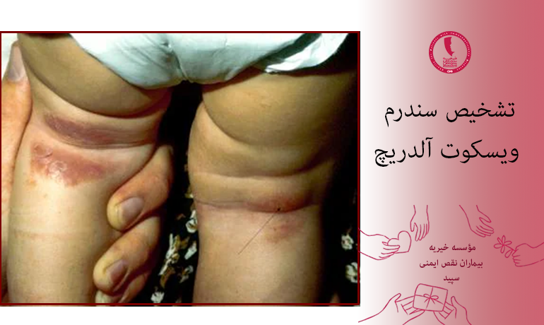 تشخیص سندرم ویسکوت آلدریچ