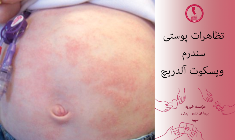 تظاهرات پوستی سندرم ویسکوت آلدریچ