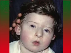 سندرم دی جرج