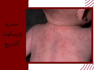 سندرم ویسکوت آلدریچ