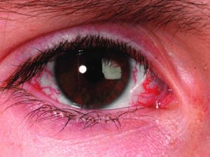 آتاکسی-تلانژکتازی