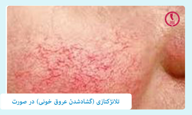 تلانژکتازی-(گشادشدن-عروق-خونی)-در-صورت