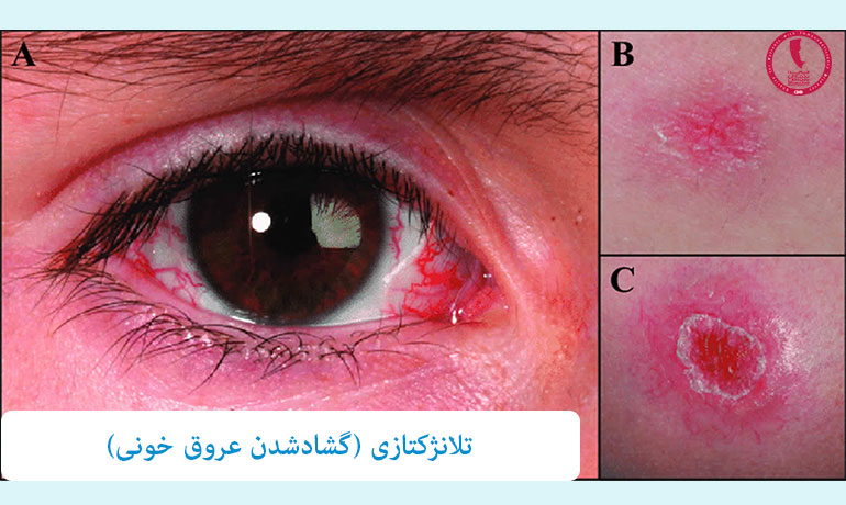 تلانژکتازی-(گشادشدن-عروق-خونی)