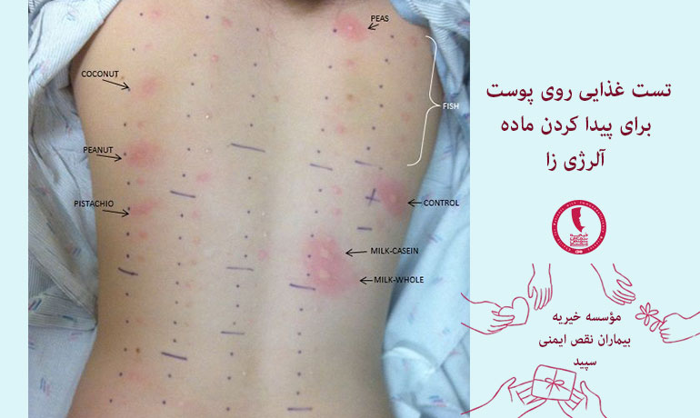 تست-غذایی-روی-پوست