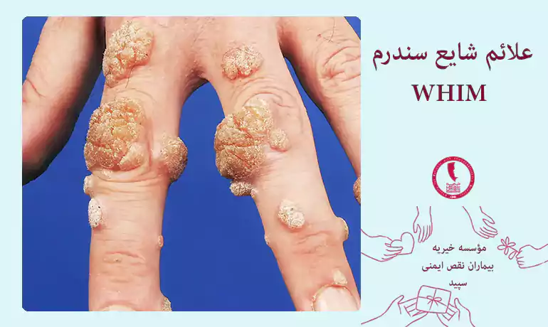 علائم شایع سندرم WHIM
