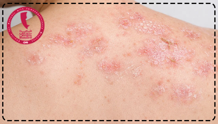 سندروم درس درمان دارد