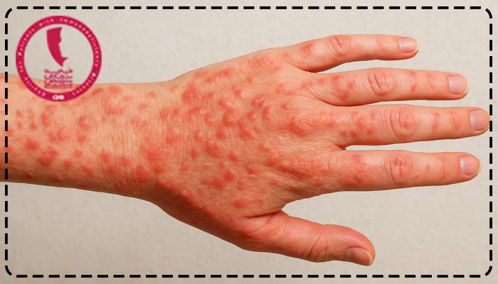 کهیر خود ایمنی