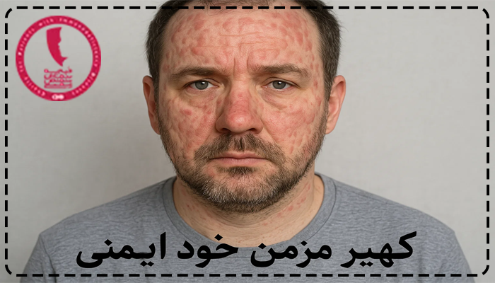 کهیر مزمن خود ایمنی